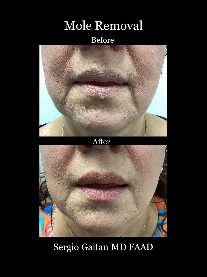 Before and after photos of mole removal.